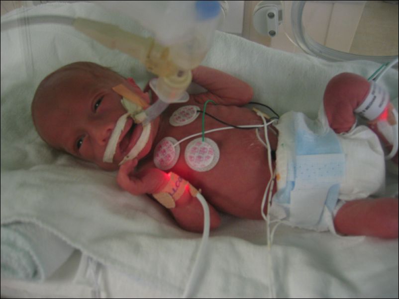 Sebastian trying to remove his tubes